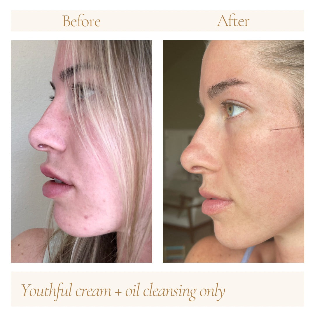 Before and after comparison of a woman’s skin using Oak & Sage Youthful Cream and Cleansing Balm only, showing reduced blemishes, redness, and smoother skin texture.