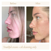 Before and after comparison of a woman’s skin using Oak & Sage Youthful Cream and Cleansing Balm only, showing reduced blemishes, redness, and smoother skin texture.