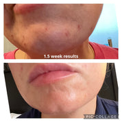 Oak & Sage Complete Skincare Set 1.5 week results showing visible improvement in acne, redness, and skin texture on chin and lower face.