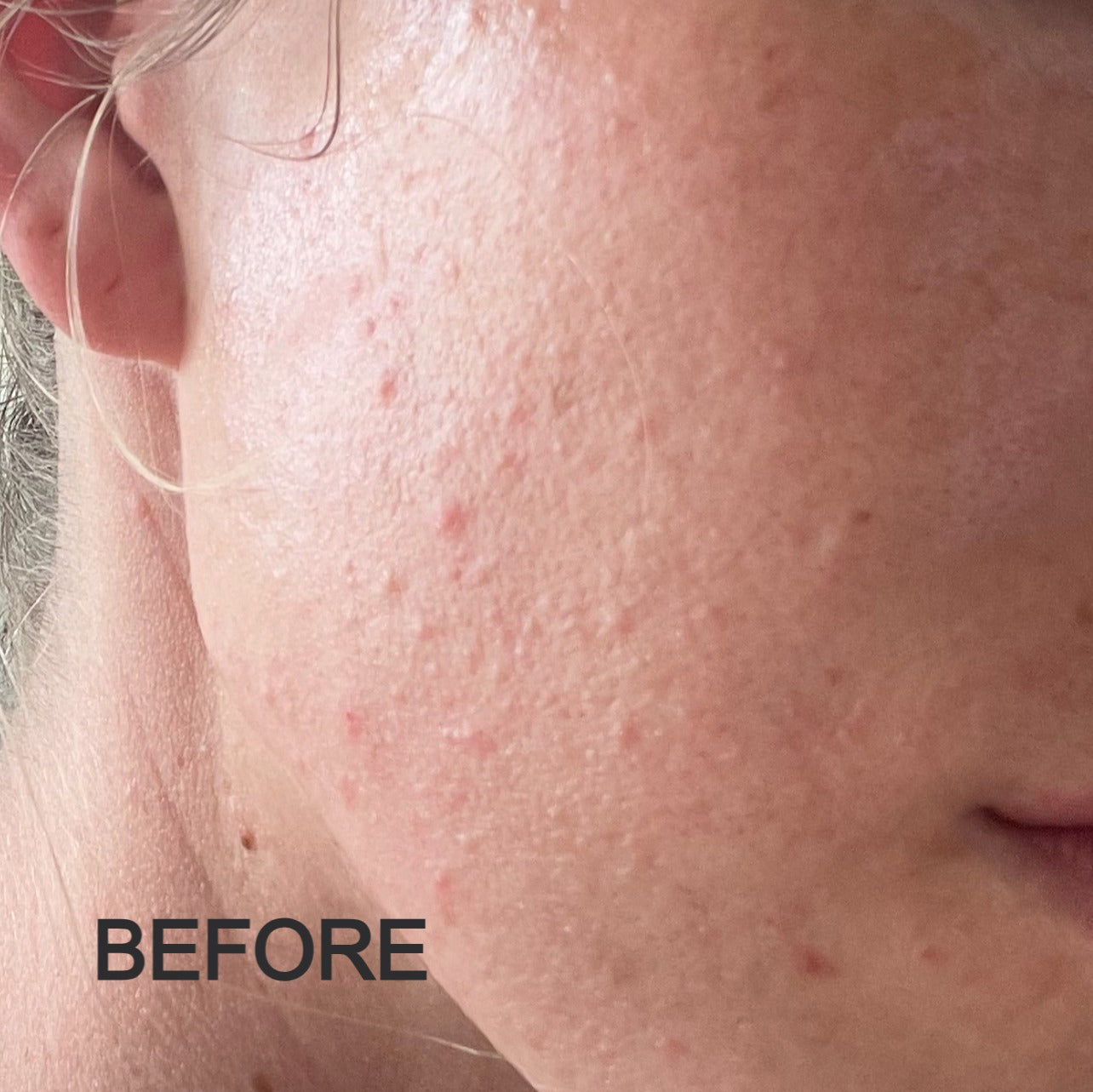 Close-up of cheek showing redness, texture, and breakouts before using Oak & Sage Exfoliating Balm.