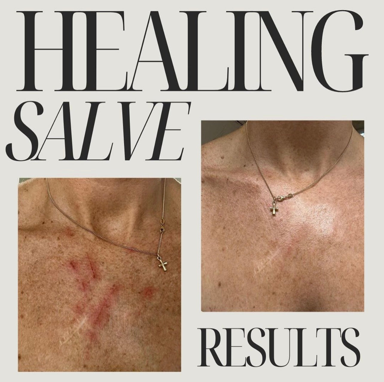 Before and after results of Oak & Sage Healing Salve showing visibly reduced redness and irritation on chest, highlighting natural skin healing benefits
