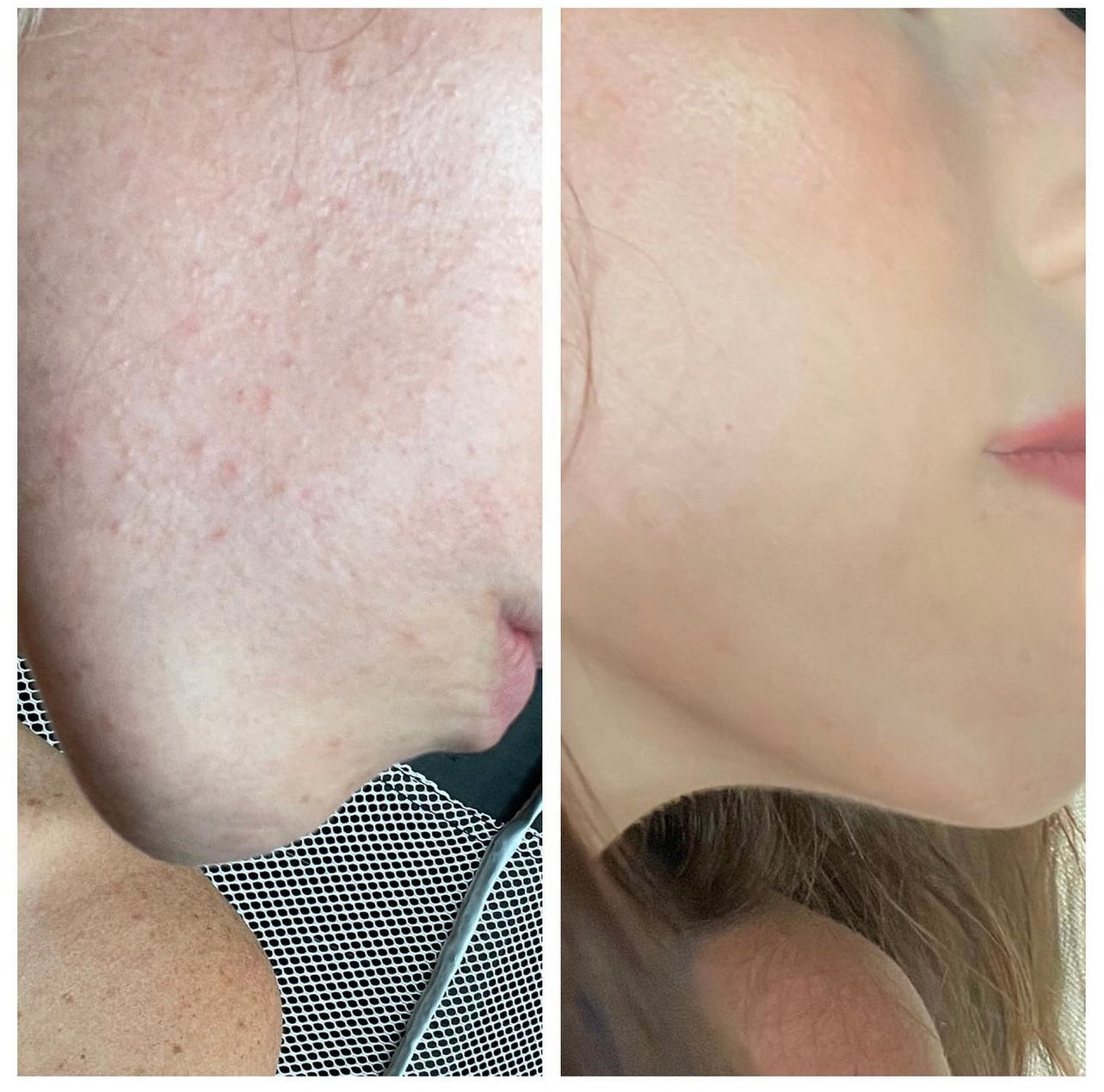 Side-by-side before and after comparison of a woman’s jawline and cheek showing smoother, clearer skin after using Oak & Sage Youthful Cream.