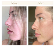 Before and after comparison of a woman’s skin using Oak & Sage Youthful Cream and Cleansing Balm only, showing reduced blemishes, redness, and smoother skin texture.