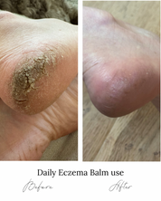 Eczema Balm